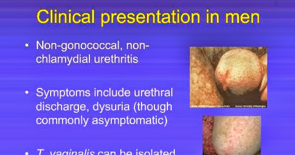 trichomonas urethritis men